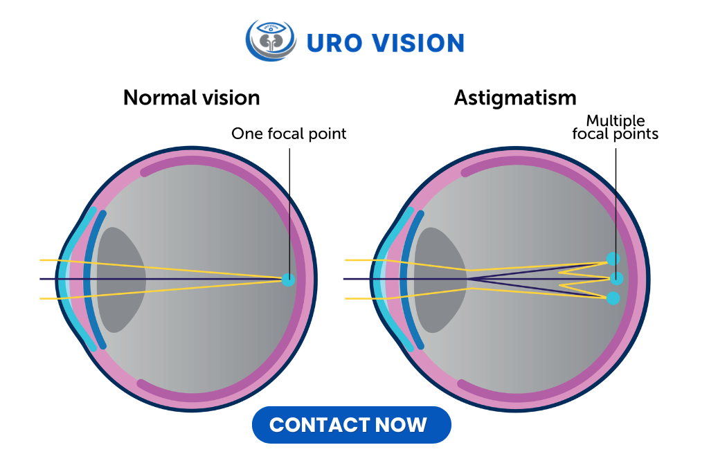 Home Understanding Astigmatism